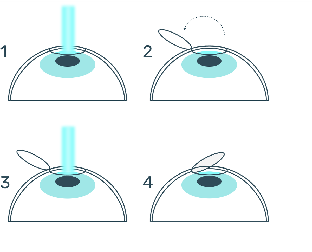 Схема 4 этапов операции LASIK